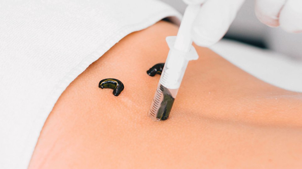 About Leeches